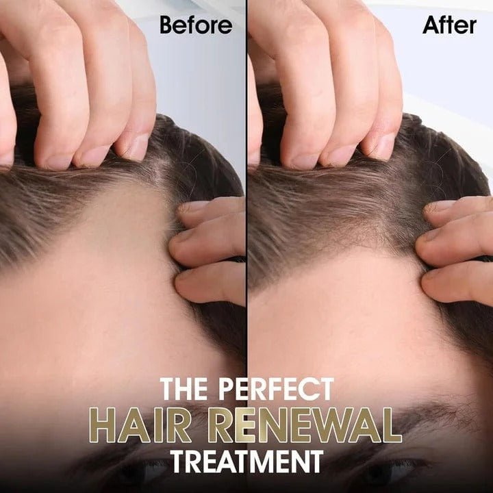 Hair Growth Therapy Derma Roller For Men And Women - My Store